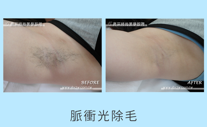 脈衝光除毛