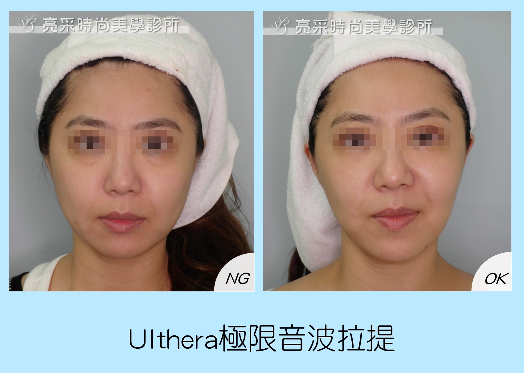 Ulthera極限音波拉提