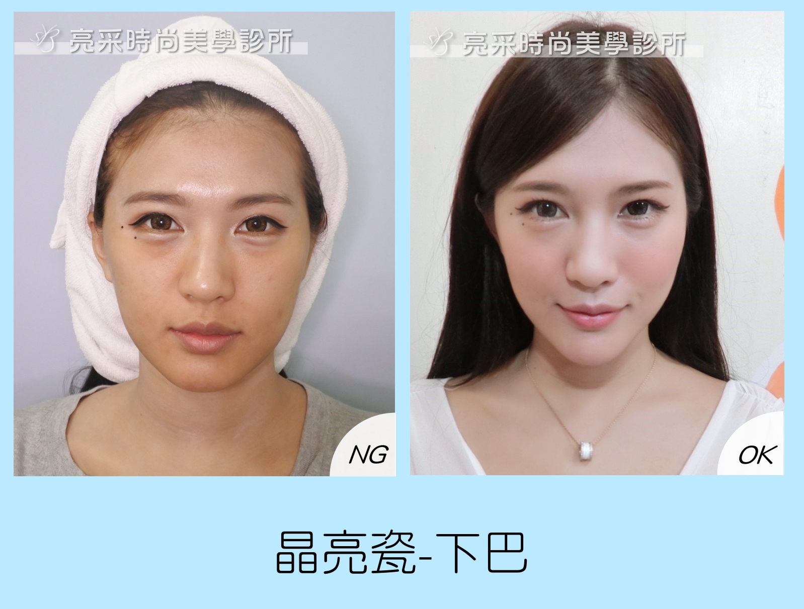晶亮瓷-下巴