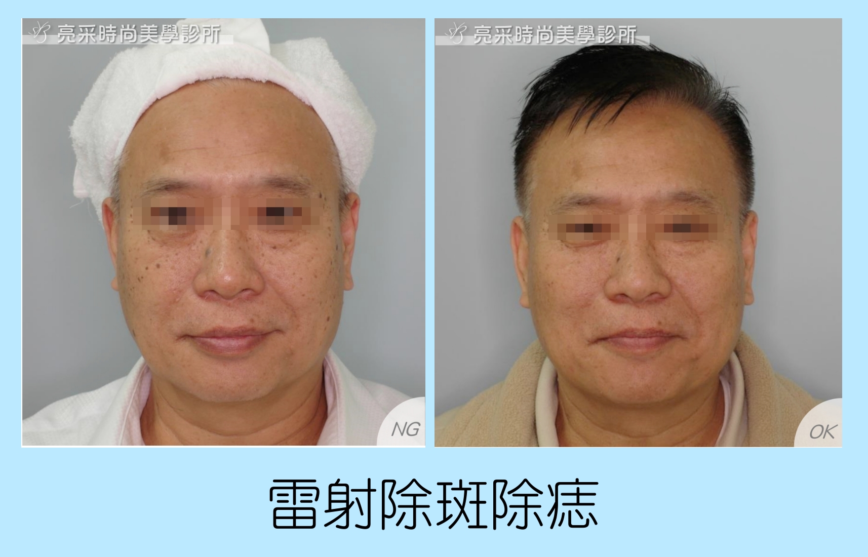 雷射除斑除痣