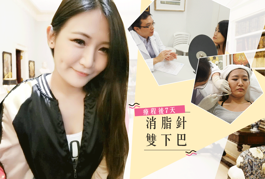 ★FB分享-雙下巴局部脂肪雕塑★