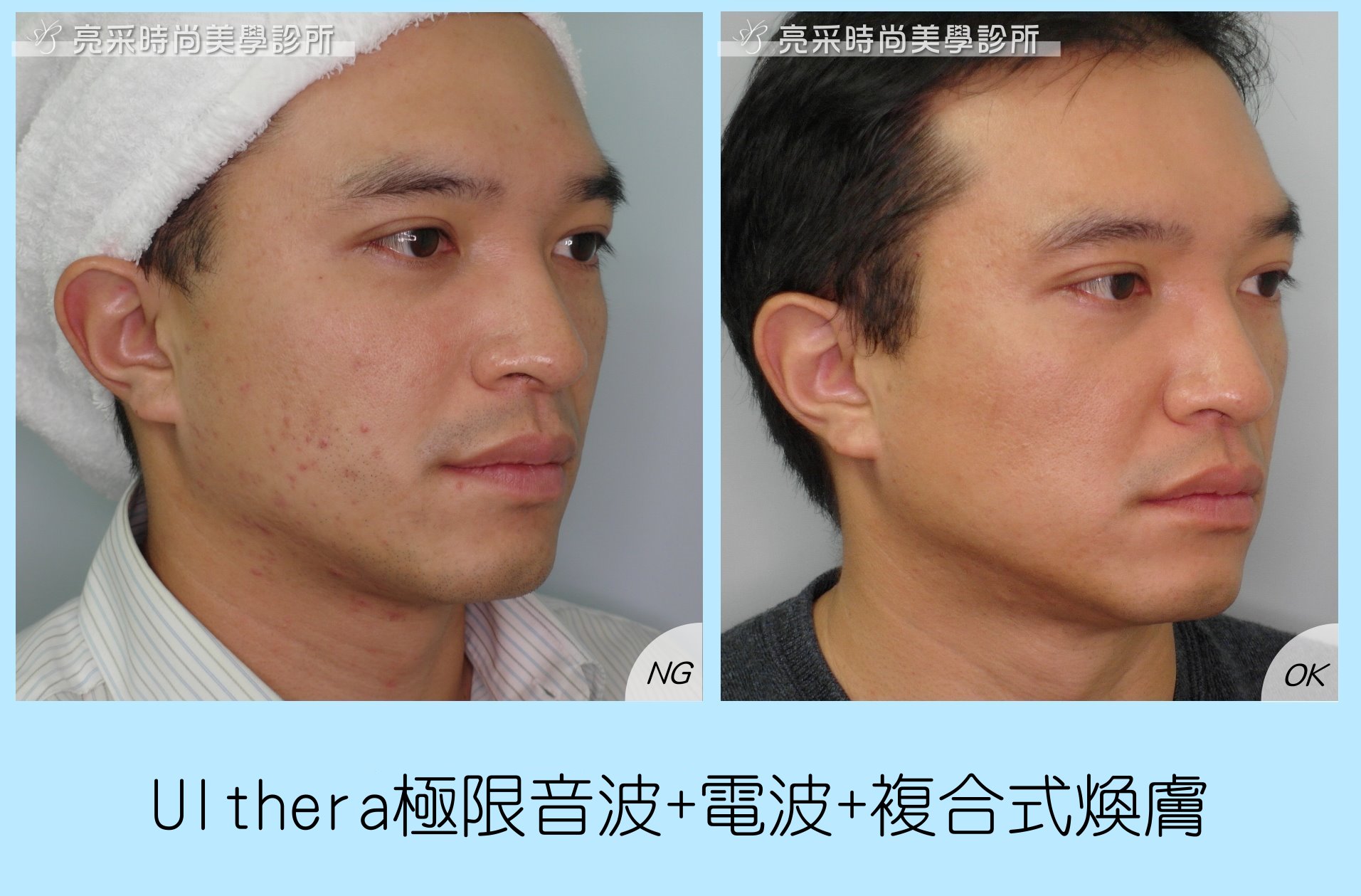 雙波拉提+複合式煥膚